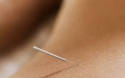 Acupuncture for Stress Relief